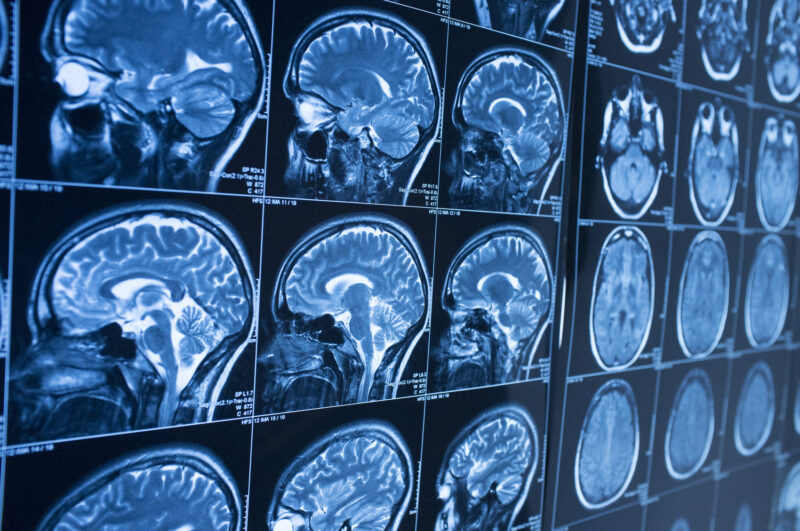 Traumatic Brain Injury Symptoms Years Later