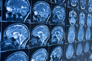 How Mission Personal Injury Lawyers Can Help With a Cerebral Palsy Claim in San Diego, CA
